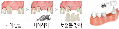 치과치료 관련 상식 치료방법